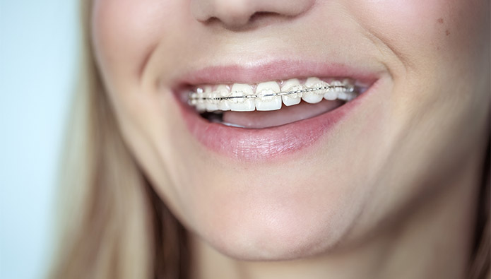  What are ceramic braces?