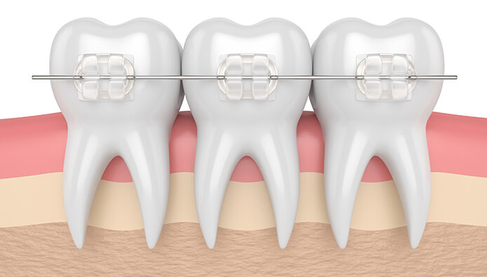  How to care for ceramic braces